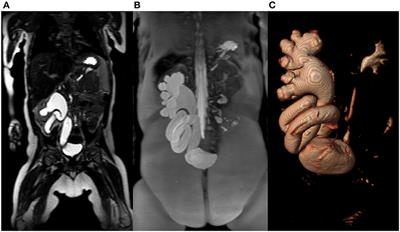 The Emerging Role of MR Urography in Imaging Megaureters in Children